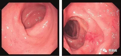 萎縮性胃炎不可怕,只要真正了解它