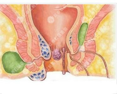 南寧哪個醫(yī)院可以做肛周膿腫？